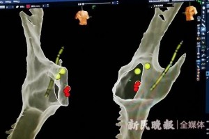 喀什二院初次成功展开全三维辅导的零曝光导管射频融化术