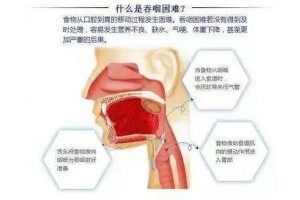 IOE技能让吞咽妨碍患者从头尝到饭菜香